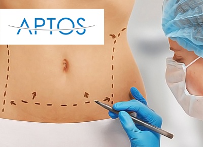 Подтяжка живота нитями Aptos